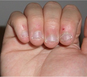 uñas mordidas